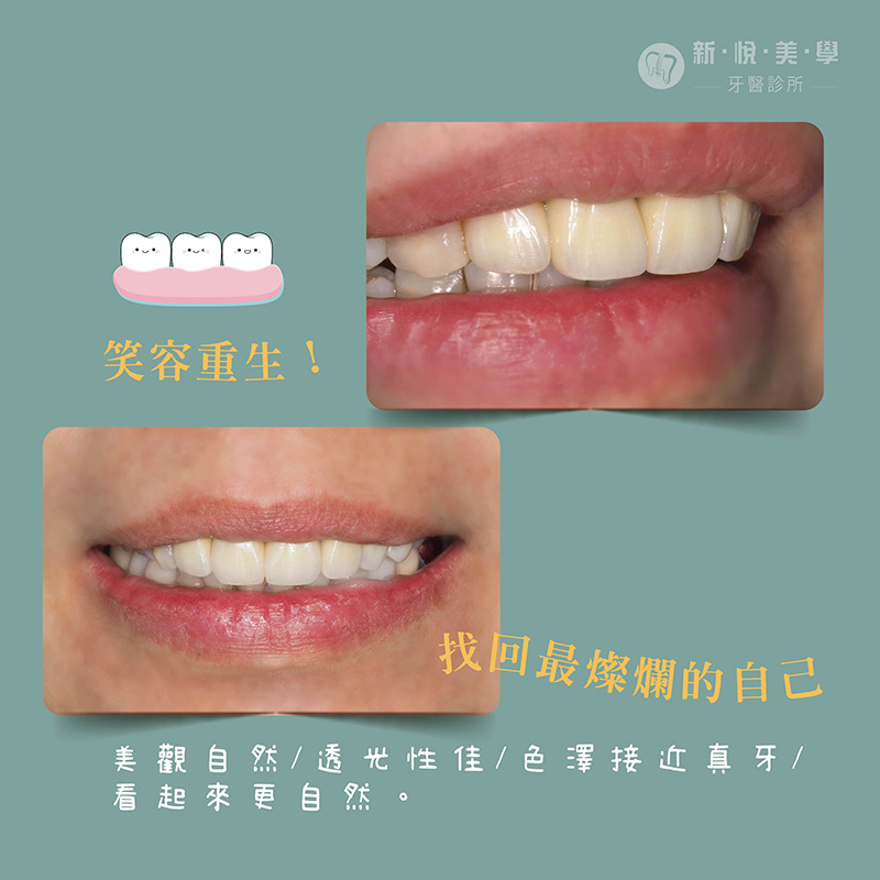 十年全瓷冠老化變色？她靠劉展亦醫師找回自信燦笑！的第2張圖片